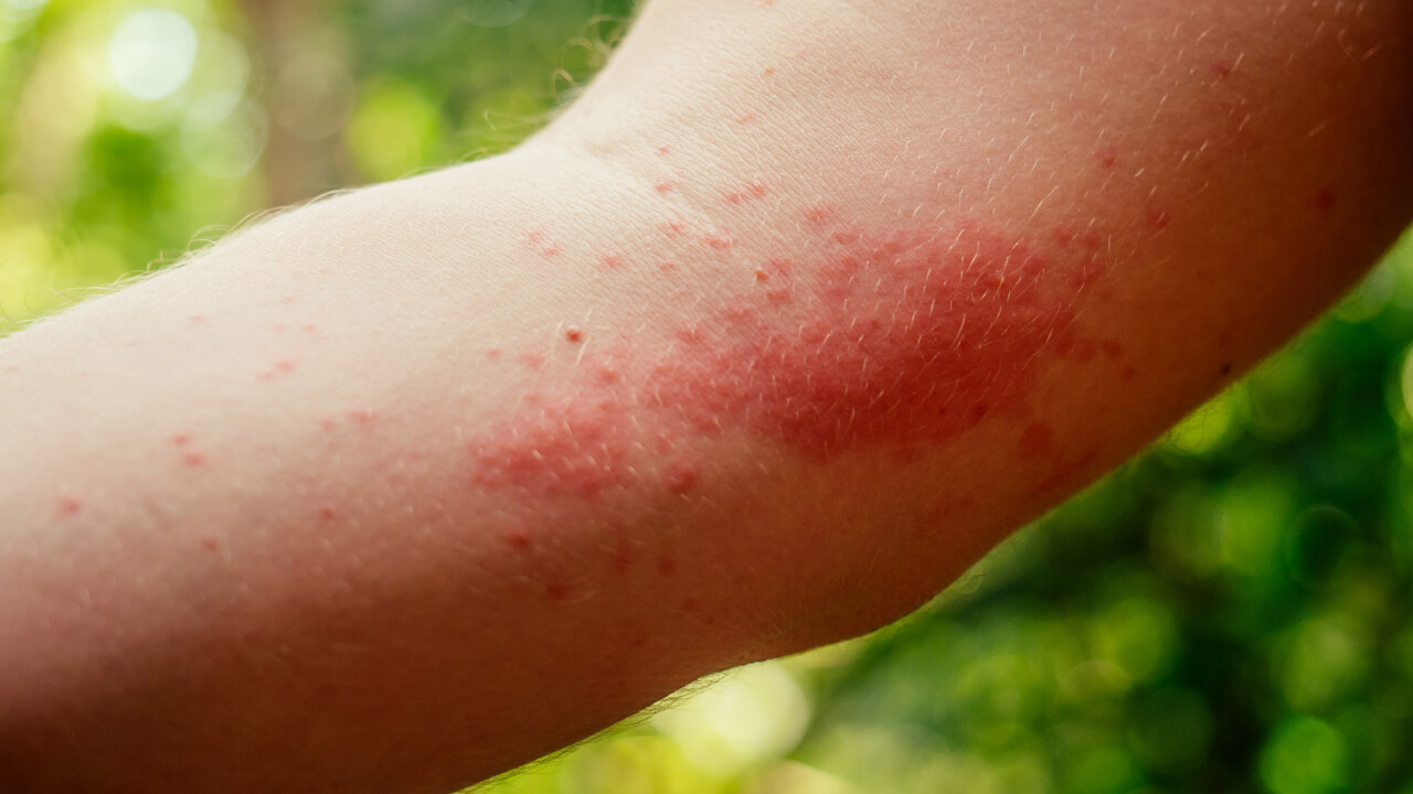 Atopijski dermatitis ili ekcem - koja je razlika - Borcat